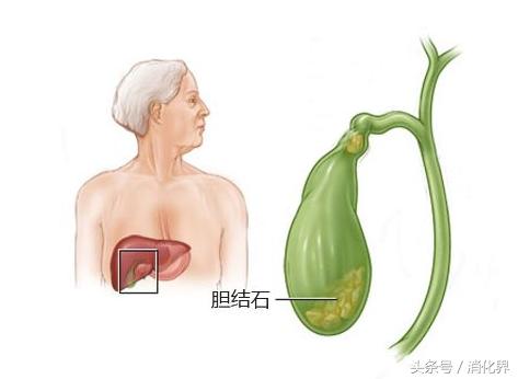 胆囊结石不能吃什么食物（胆囊结石饮食注意事