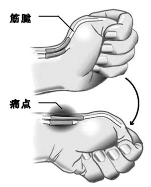 腱鞘炎最佳治疗方法以及日常护理