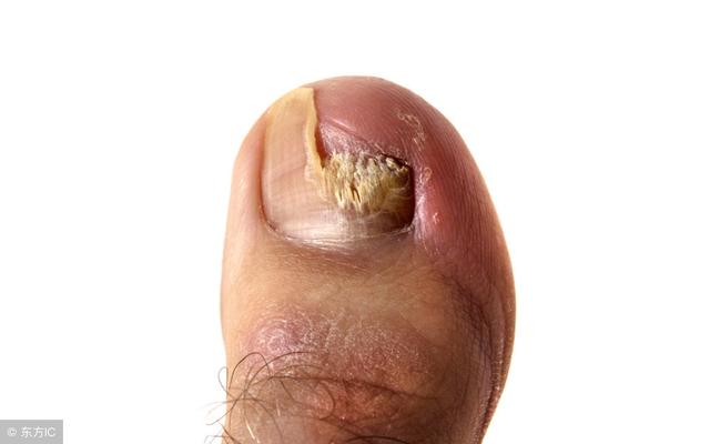 导致灰指甲产生的因素有很多，预防灰指甲的方法这里找