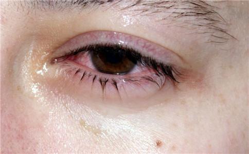结膜炎用什么眼药水（结膜炎有哪些症状）