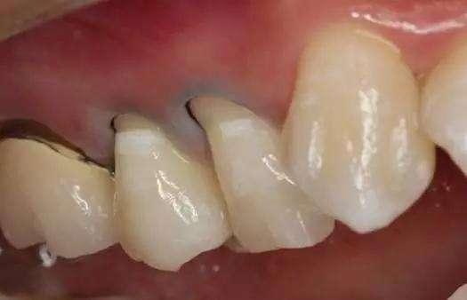 牙石是什么原因引起的？教你一个牙石清洁小窍