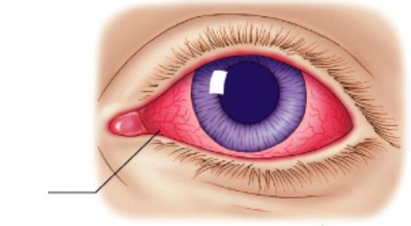 角膜炎和结膜炎的区别 以及用什么眼药水合适