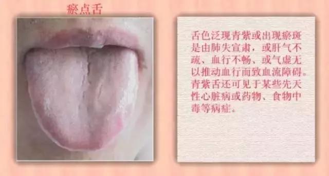 老中医舌珍总结：九种体质+珍贵的舌诊图谱，拿镜子看看