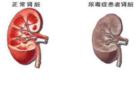 怀孕尿检白细胞偏高，有什么影响？