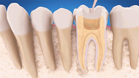 牙齿做根管治疗到底有多恐怖？