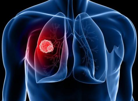 查出肺癌晚期到底能活多久？且听专家解析肺癌晚期的一些情况！
