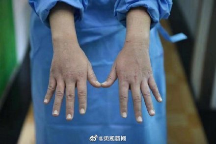22岁感染科护士的手是什么样的 22岁感染科护士的手照片曝光令人心碎