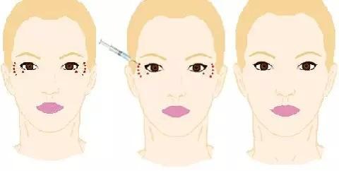 女人！眼角纹的这些事，你肯定不知道