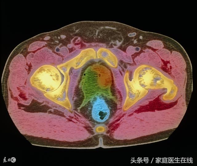 为什么你小便老是分叉？原来这3种大病早就盯上你！