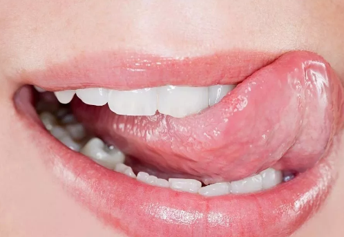 舌苔厚腻怎么办 舌苔厚腻食疗方法是什么