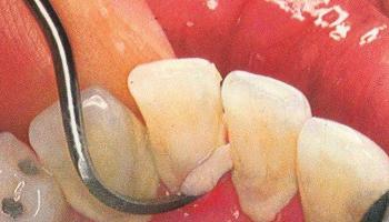 牙结石到底是怎么形成的 大部分人都错了