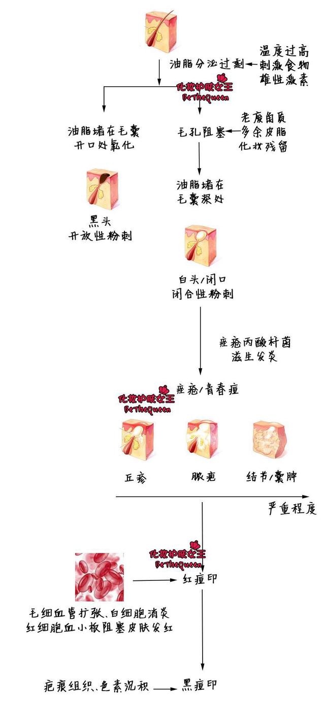 长痘不可怕，可怕的是痘印！教你如何消除痘印100%有效！