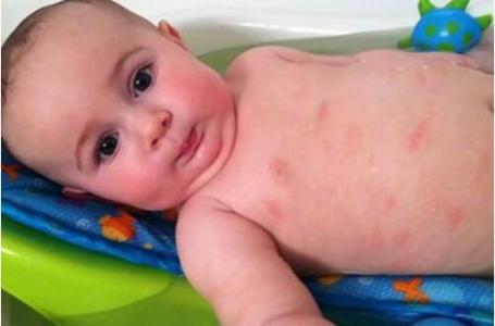 婴儿湿疹原因以及治疗的方法（宝妈必看）