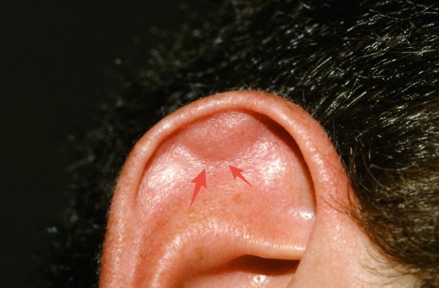 皮肤科医生：耳朵后面长了疙瘩，4个原因别忽视！
