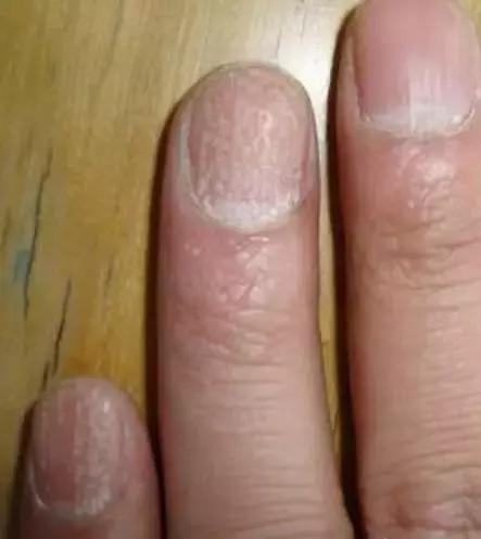 指甲上的月牙、竖纹代表什么？这8种指甲问题，一出现就是大事！
