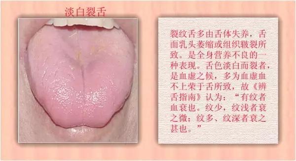 老中医舌珍总结：九种体质+珍贵的舌诊图谱，拿镜子看看