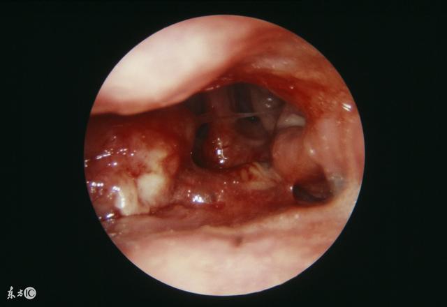 鼻咽癌早期有这5大症状，快看看你有没有！