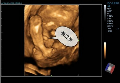 如何通过彩超单数据判断胎儿性别（简单）