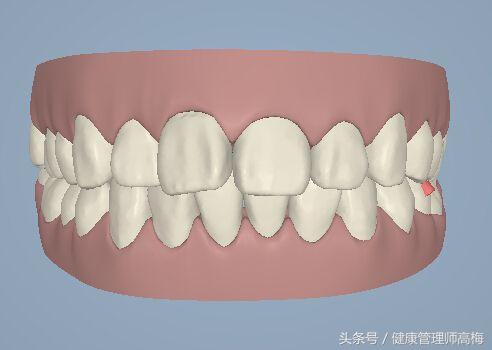 成人磨牙是病兆，睡觉磨牙根源一招教你消除