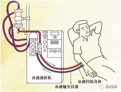 什么是血液透析，血液透析的原理是什么？