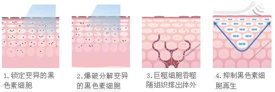 遗传性的雀斑能去掉吗，什么办法比较好？