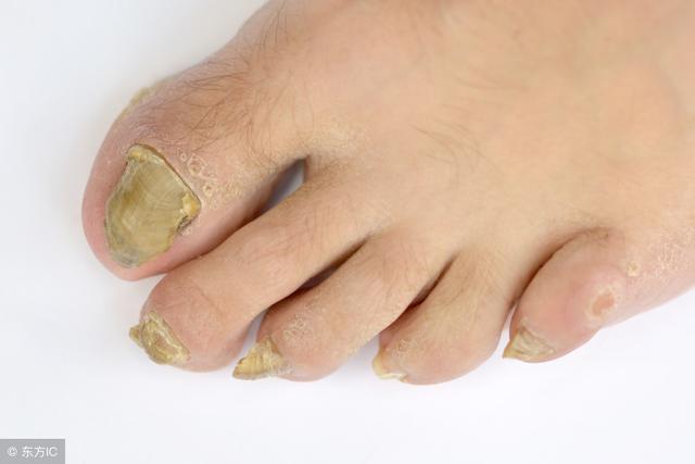 灰指甲是怎么引起的，预防灰指甲的方法！