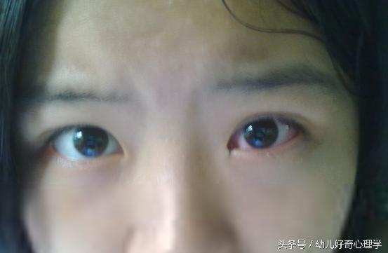 幼儿得了“红眼”怎么办，红眼病吃什么？老中医来支招、、、