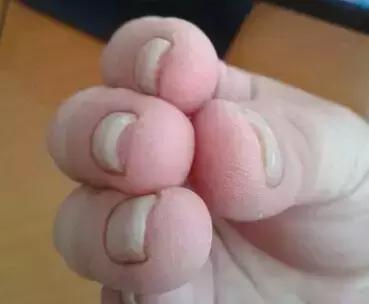 指甲上的月牙、竖纹代表什么？这8种指甲问题，一出现就是大事！