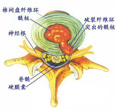 腰间盘突出怎么治疗，不花钱在家就可以解决！