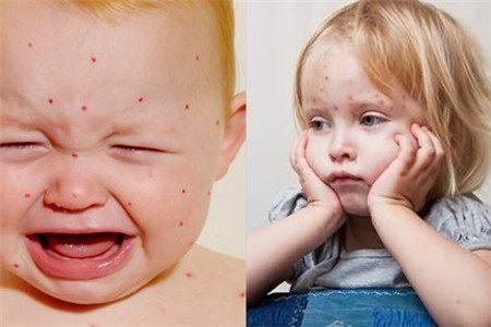 水痘初期症状有哪些 这几种症状要知道