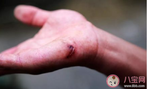 你身上的疤痕都是什么情况留下的 淡化身上疤痕的方法有哪些