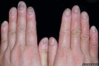 6个方法消灭你的灰指甲