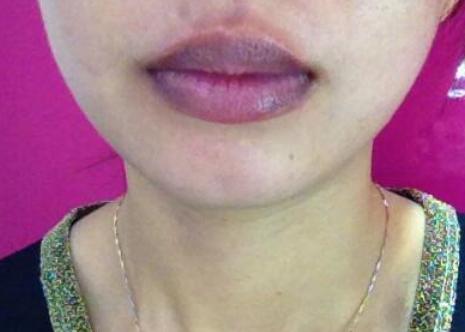 嘴唇发紫的原因是什么？嘴唇的颜色可预示你身体的健康状况